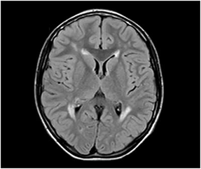 Infantile-Onset Charcot–Marie–Tooth Disease With Pyramidal Features and White Matter Abnormalities Due to a De novo MORC2 Gene Variant: A Case Report and Brief Review of the Literature
